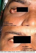 Before After Pictures,Delhi,eyelid tumor,reconstruction
